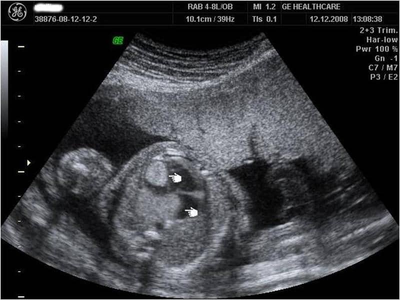 Fetal Cardiac Rhabdomyoma Fetal Cardiac Rhabdomyoma