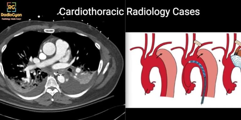 Cardiothoracic radiology case with a CT scan showing dissection of the aorta