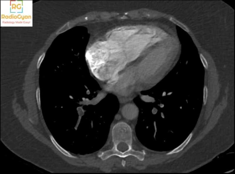 Pulmonary embolism diagnosis : What MORE does the radiologist need to report!