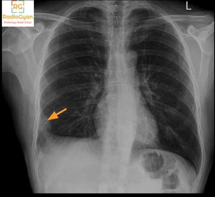 chest x ray pulmonary embolism