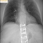 Pulmonary Artery Embolism after Vertebroplasty: Quiz case