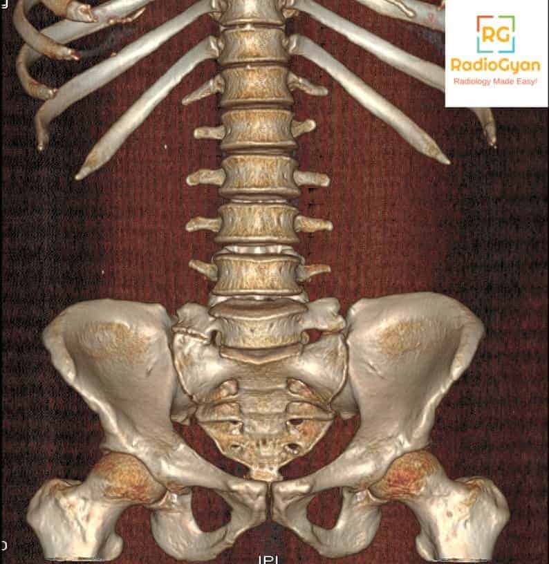 Lumbosacral transition vertebra normal variant anatomy radiology