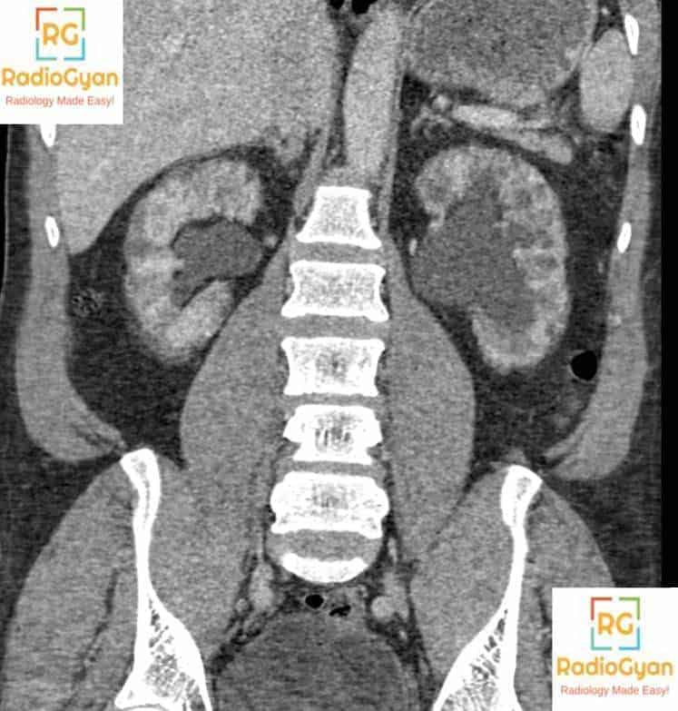 Lithium Nephropathy Radiology 1 