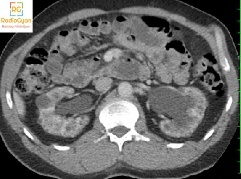 Lithium Nephropathy Radiology Reference Article Cases Radiogyan