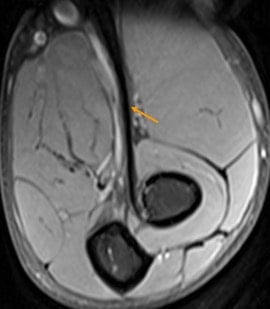 FABS MRI biceps tendon