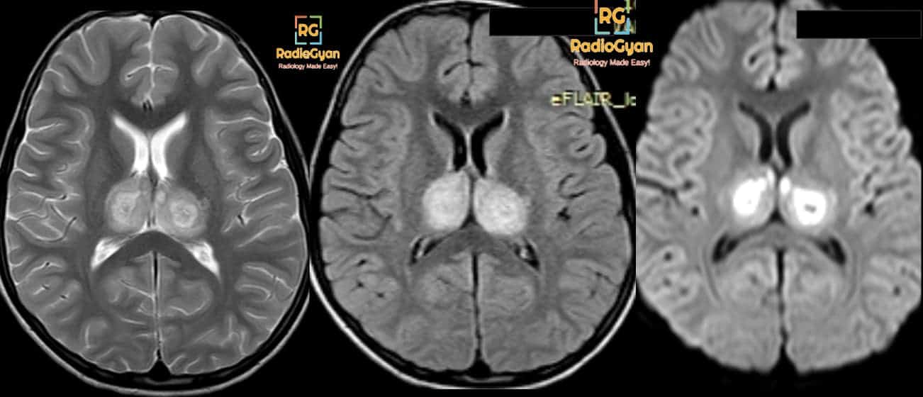 MRI brain showing Japanese encephalitis Aunt Minnie Radiology Case