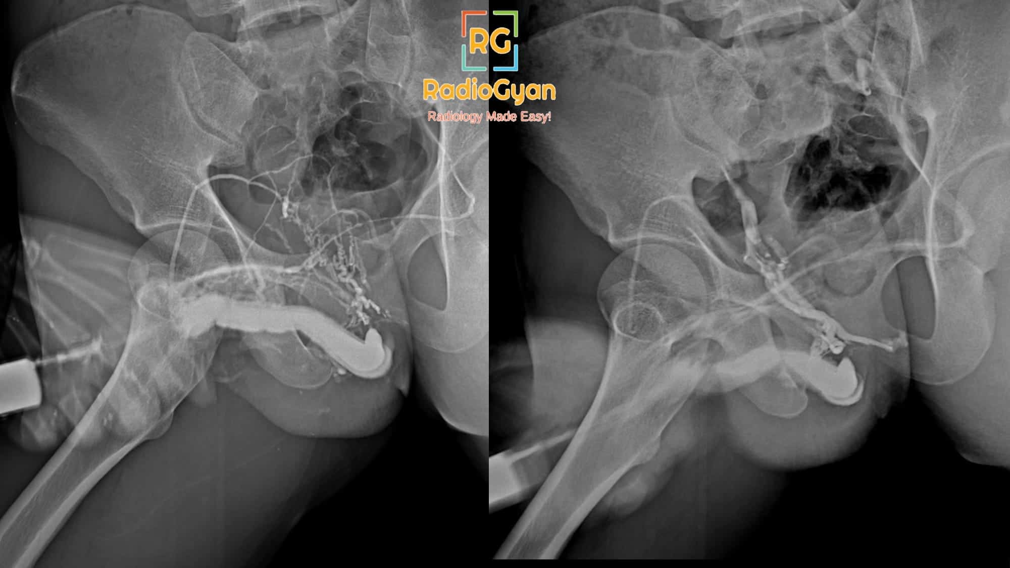 Venous intravasation of contrast on retrograde urethrogram learning radiology cases