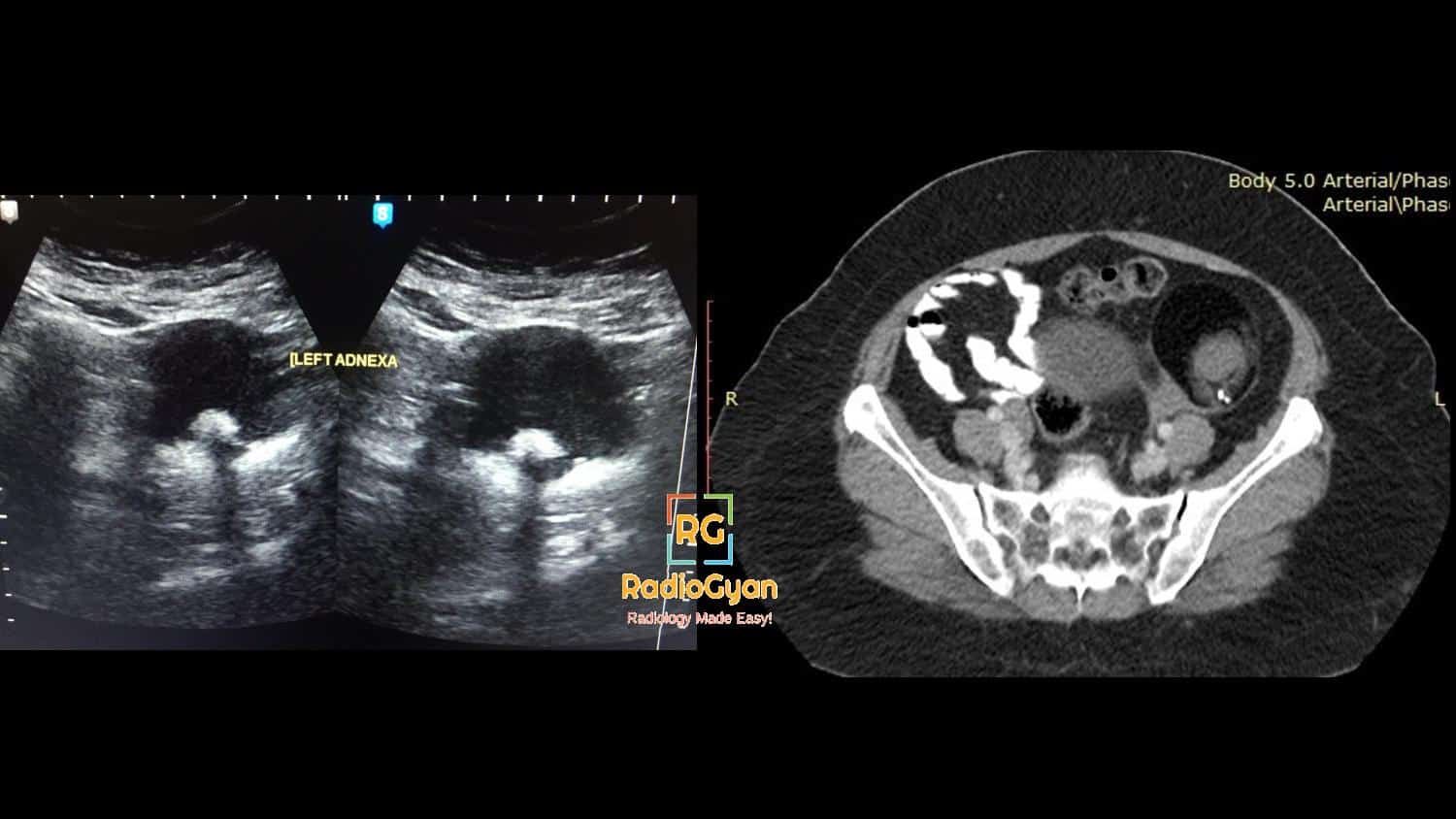 Imaging features of an ovarian dermoid cyst on CT and USG Ultrasound Interesting Radiology cases