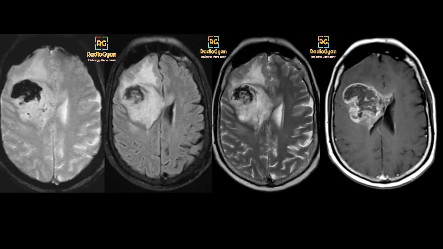 MRI of Glioblastoma Multiforme Radiology Cases Quiz