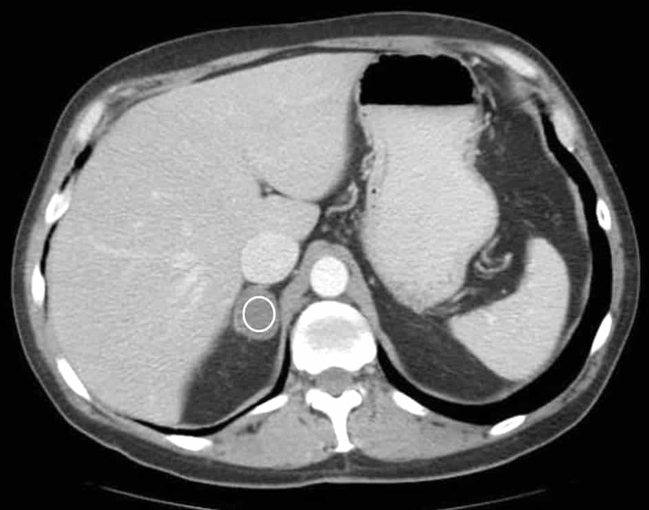 Adrenal CT Washout calculator. Аденома надпочечника у мужчин что это