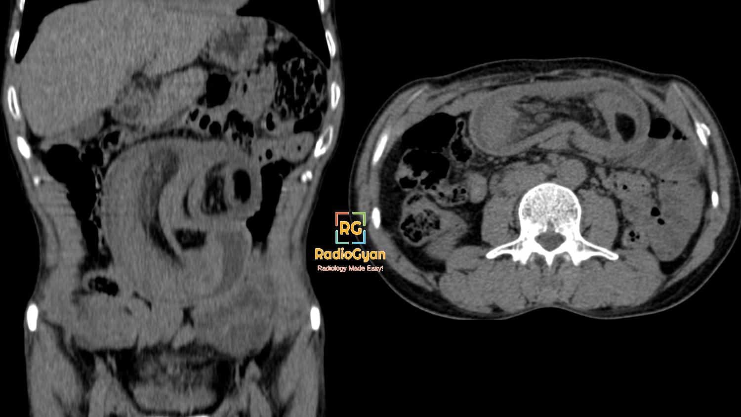 Axial and coronal CT showing ileo-ileal intussusception due to ileal lipoma and resultant mesenteric volvulus
