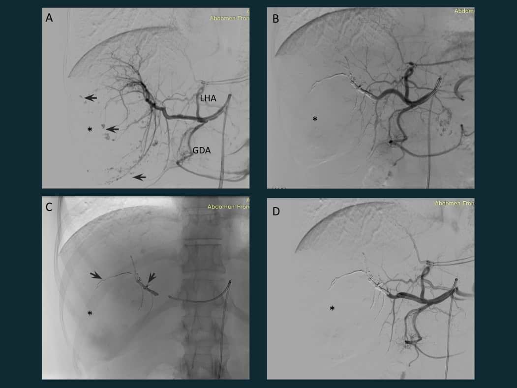 Giant hepatic hemangioma embolisation IR