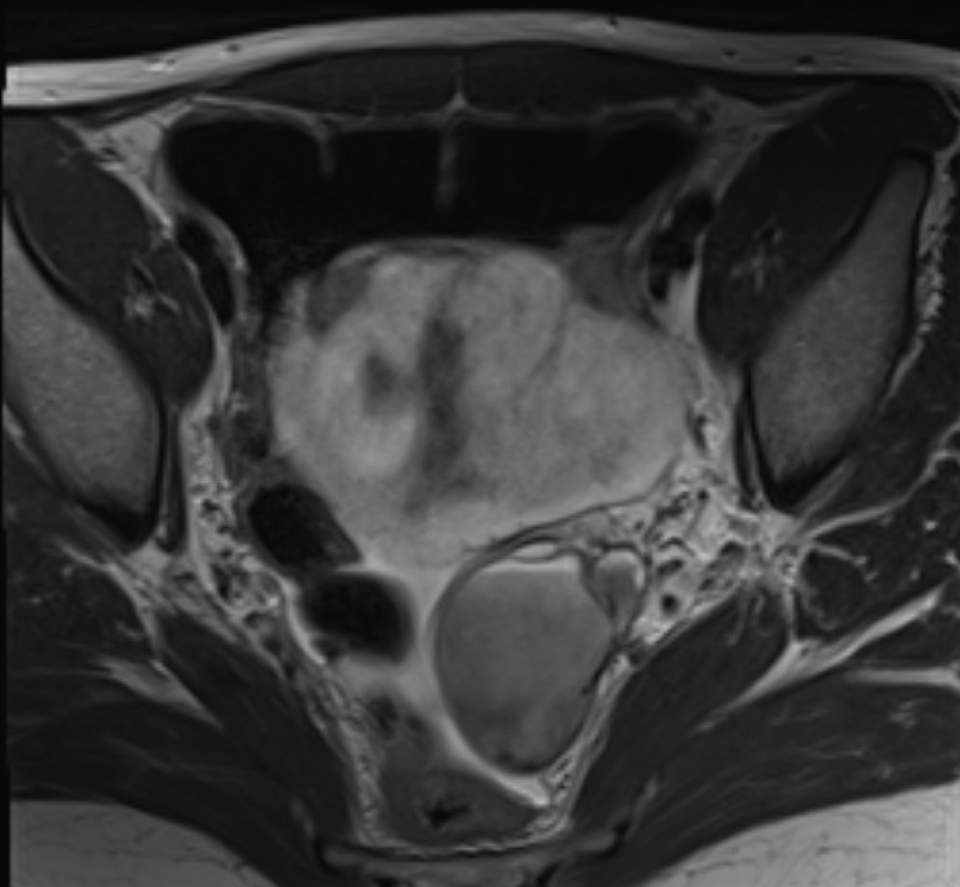 T2 shading in a case of endometriosis on MRI
