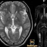 Neurofibromatosis Radiology Case