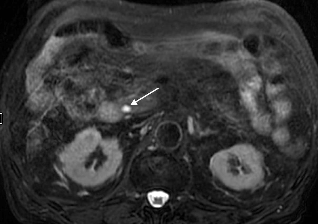 T2 fat saturated MRI image of Choledochal Cyst