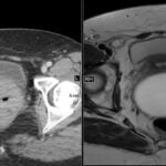 Canal of Nuck cyst MRI and CT