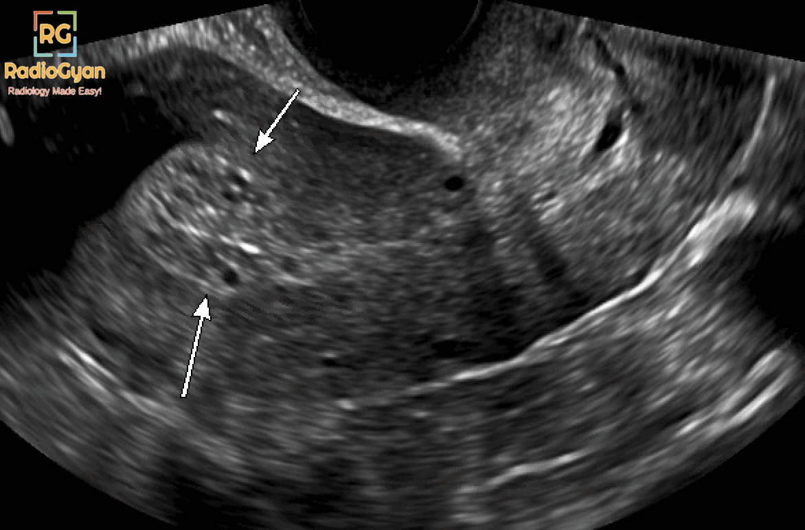 endometrium çift duvar kalınlığı | seyma-isik