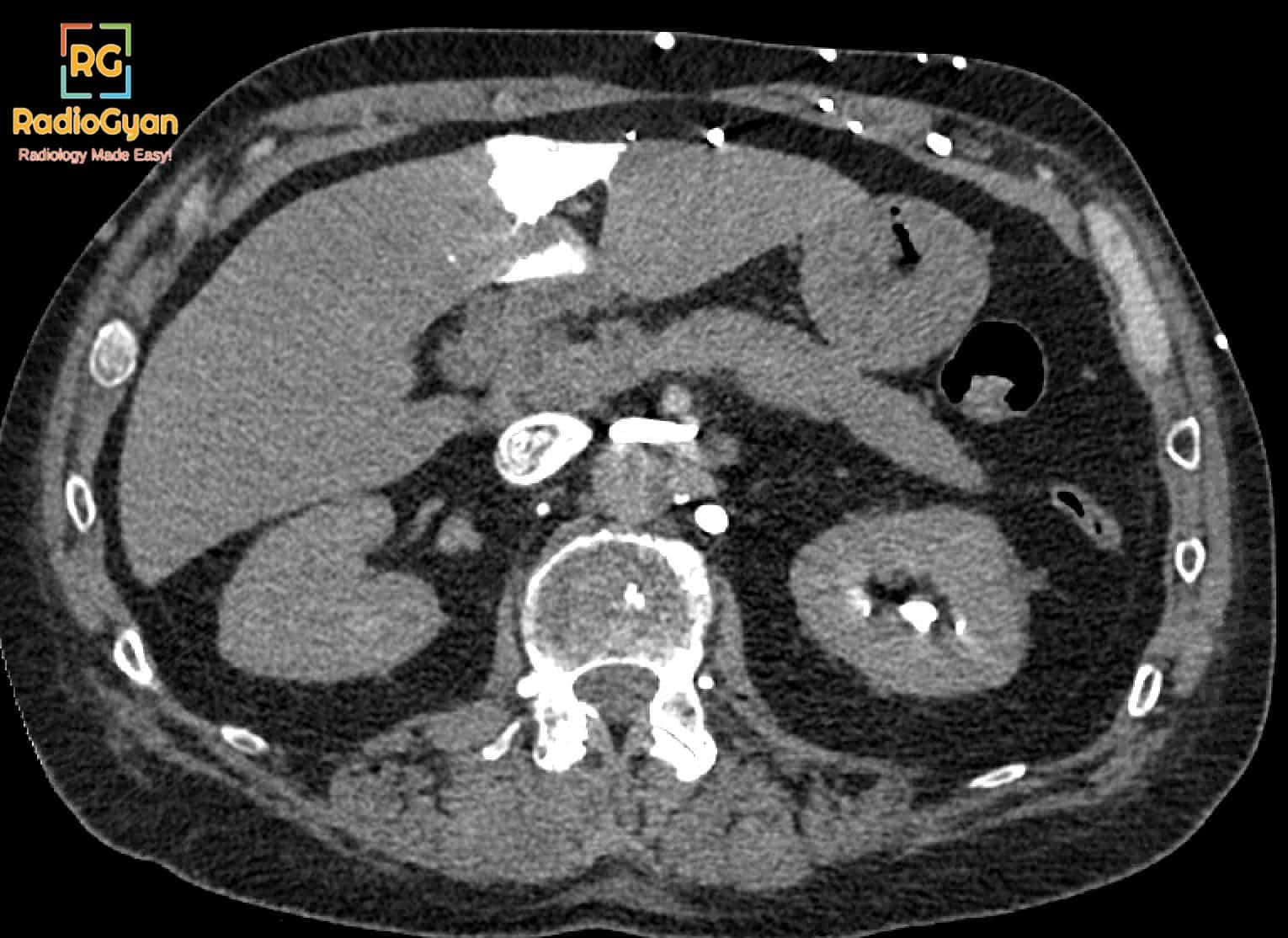 Hot Quadrate Lobe Sign -, Radiology Cases