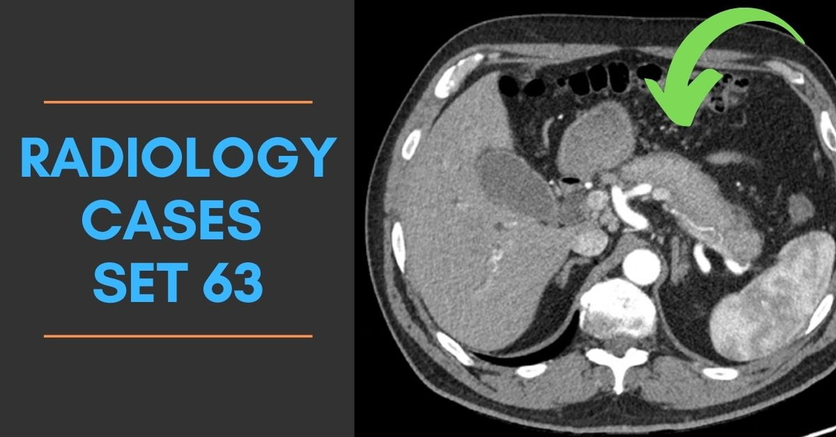 Radiology Quiz Cases Autoimmune Pancreatitis CT