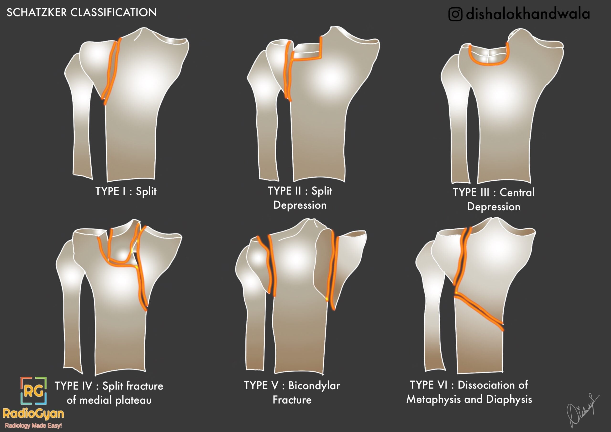 schatzker-classification-of-tibial-plateau-fractures-radiogyan