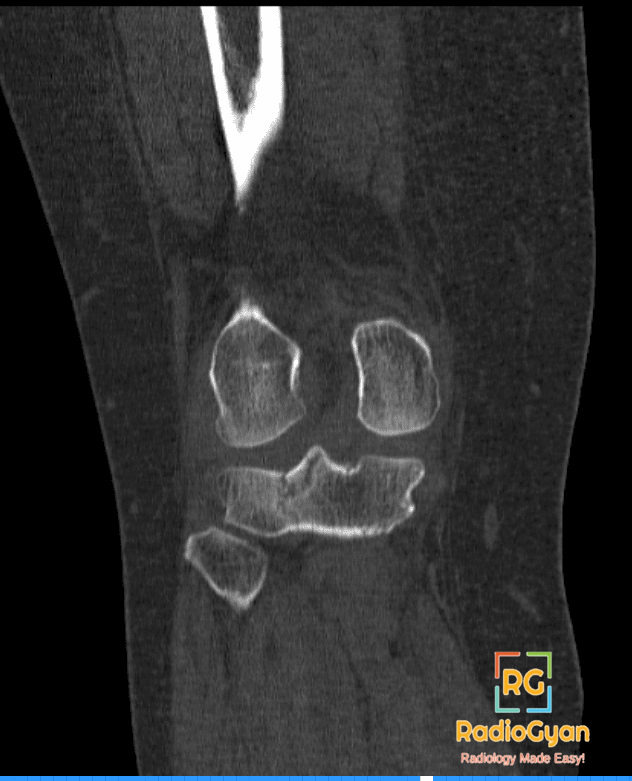 Tibial Plateau Fracture CT