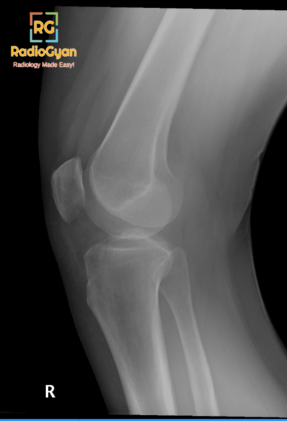 Tibial Plateau Fracture RadioGraph Lateral