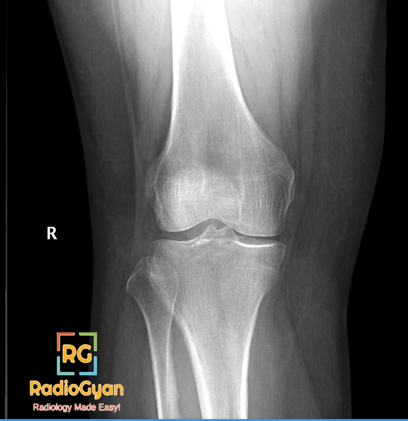 Tibial Plateau Fracture RadioGraph frontal view