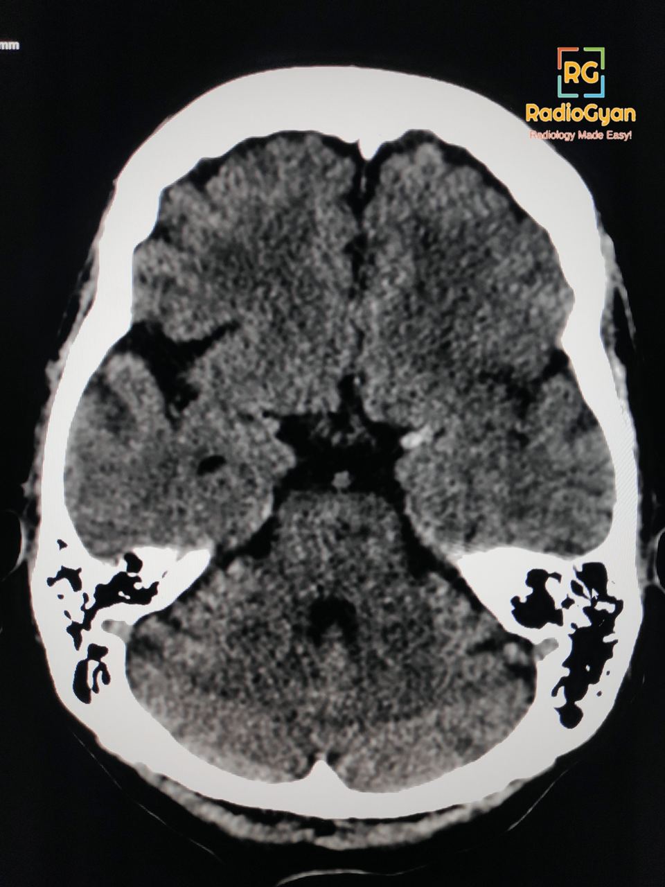 Dense left MCA sign with acute infarct