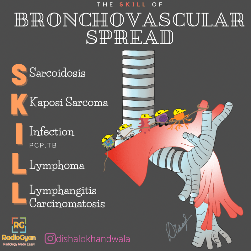 Bronchovascular Spread Mnemonic