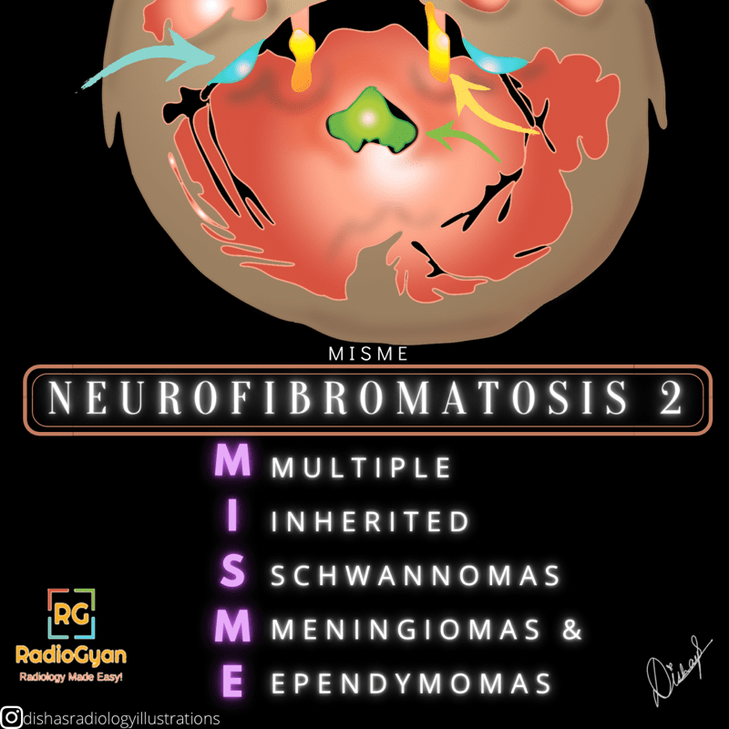 Neurofibromastosis 2 Features Mnemonic