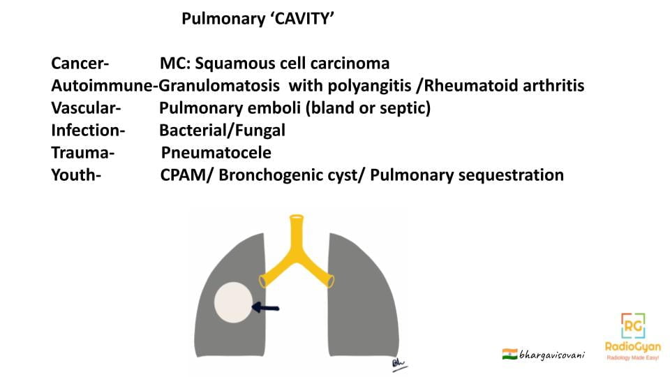 Pulmonary Cavity Mnemonic
