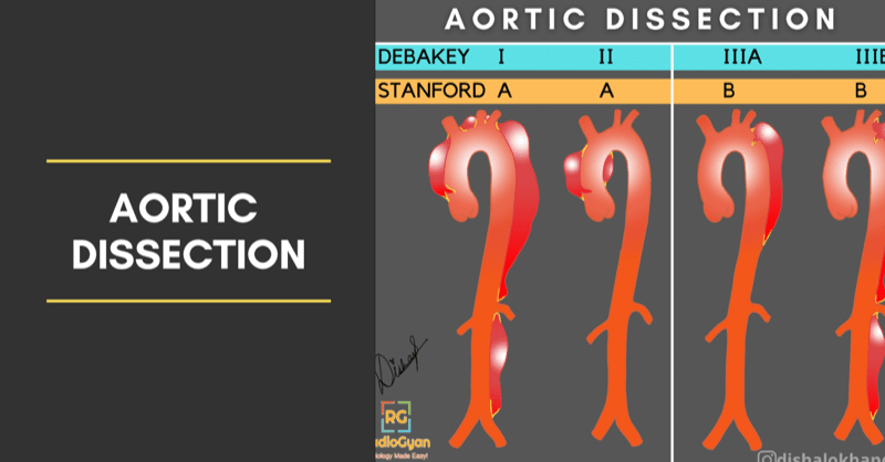 Aortic Dissection Radiology