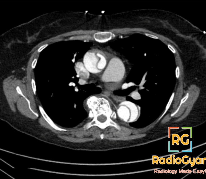 aortic dissection x ray