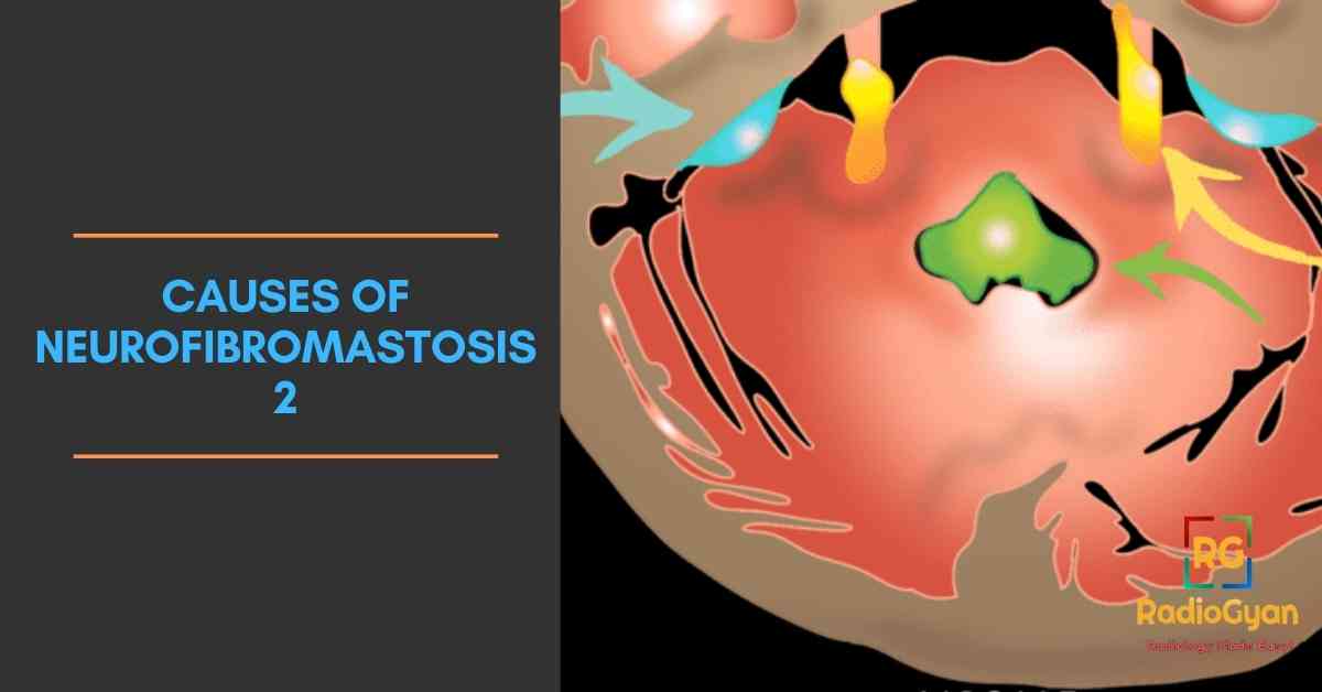 causes of Neurofibromastosis 2
