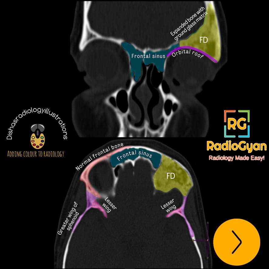 Fibrous Dysplasia Radiology Case Radiogyan