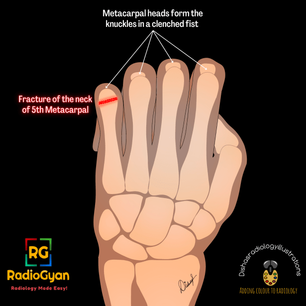 Boxers Fracture Why Is It A Misnomer Radiology Case Radiogyan