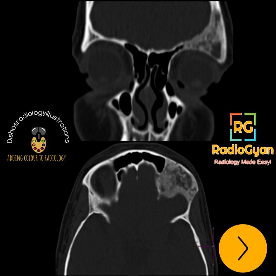 CT-Fibrous-dysplasia-1-1