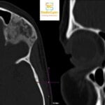 CT Fibrous dysplasia frontal bone