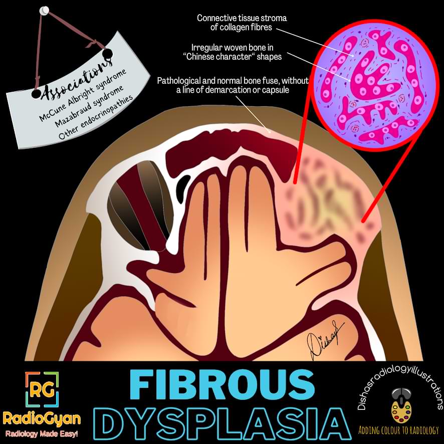 Illustrated Image of Fibrous Dysplasia