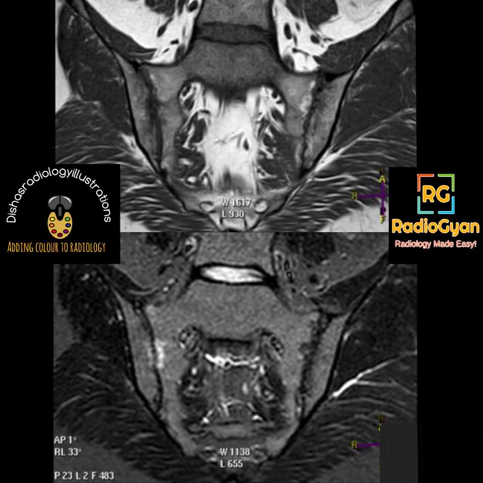 sacroilitis-radiology-case-radiogyan