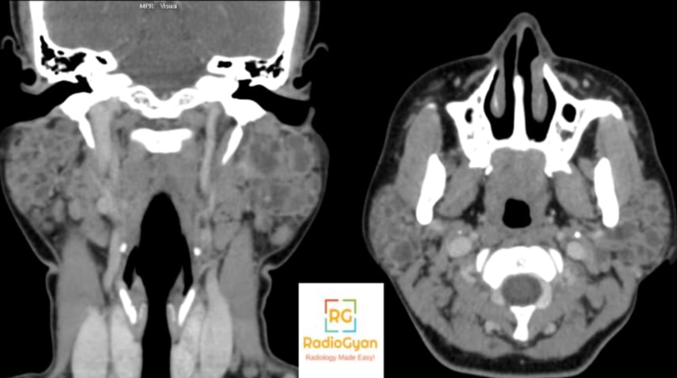 submandibular gland cyst