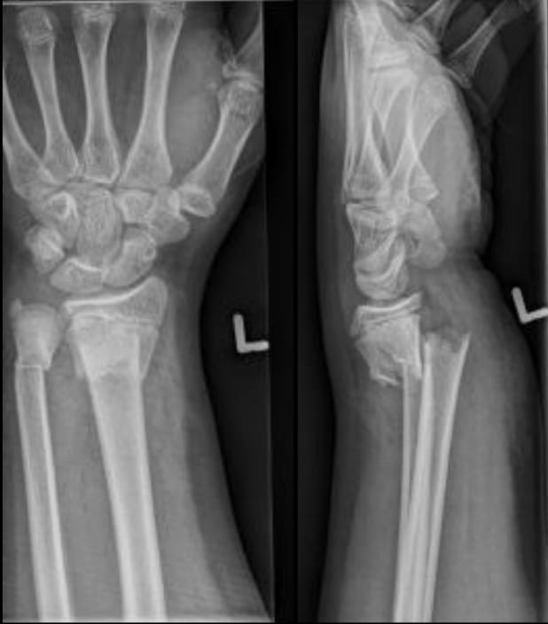 Frontal and lateral radiographs showing Colle fracture