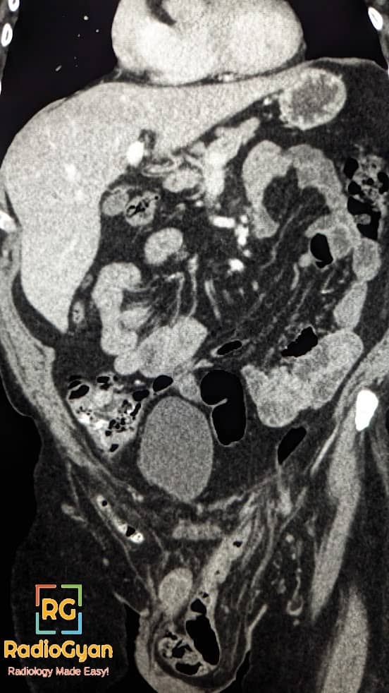 Amyand Hernia CT image