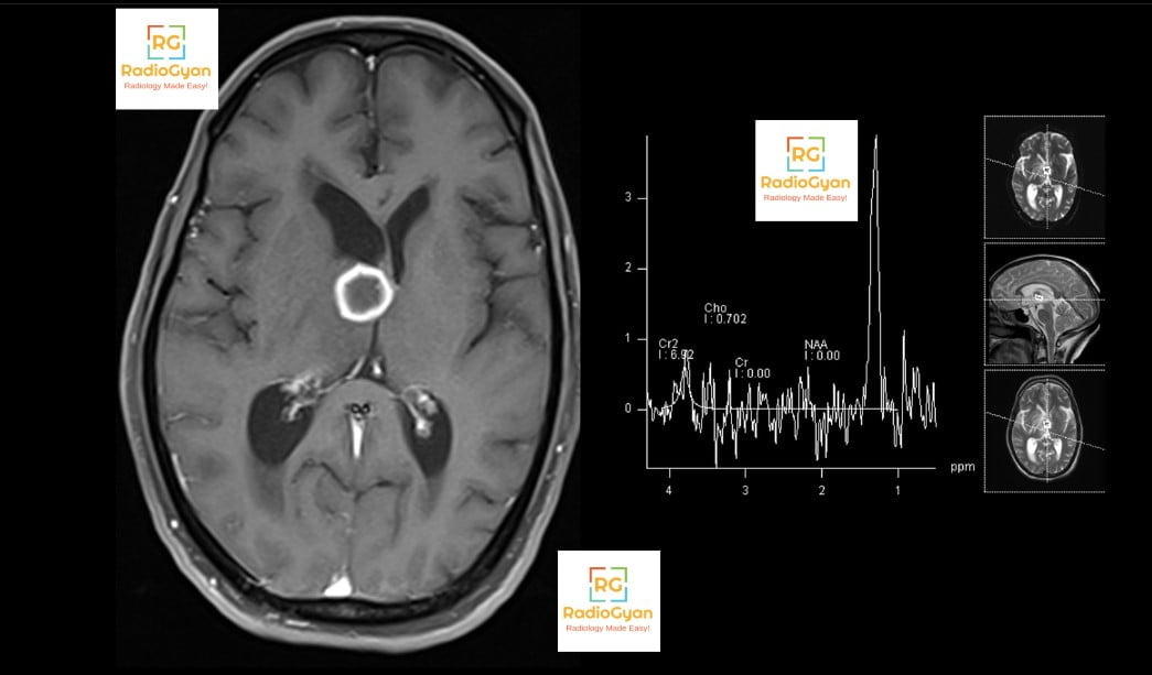 Tuberculoma Radiology Case