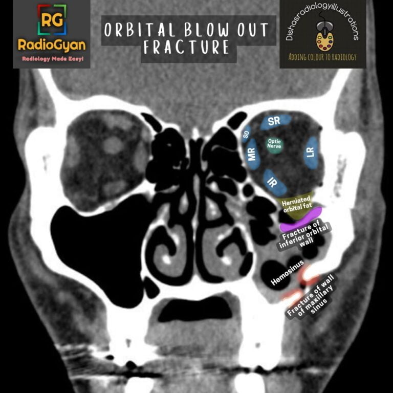 Blow out fracture of the Orbit | Radiology Case