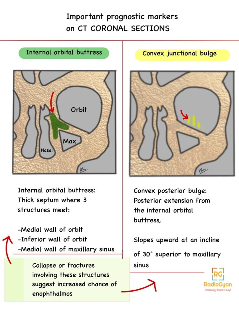 Blow out fracture of the Orbit | Radiology Case