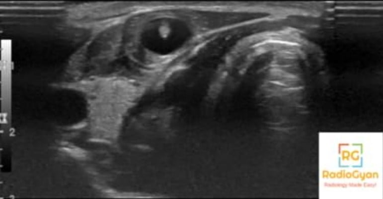Intramuscular Cysticercosis Radiology Case