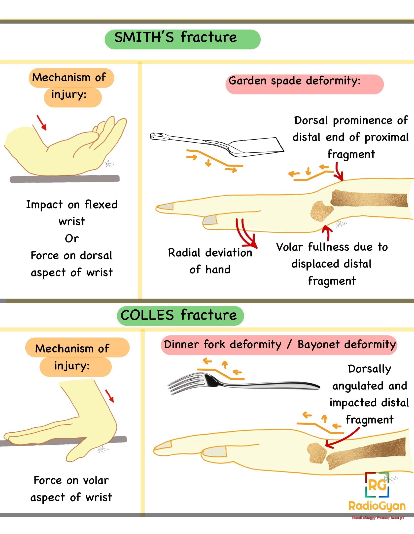 Colle Fracture - Distal Radial Fracture, Radiology Case