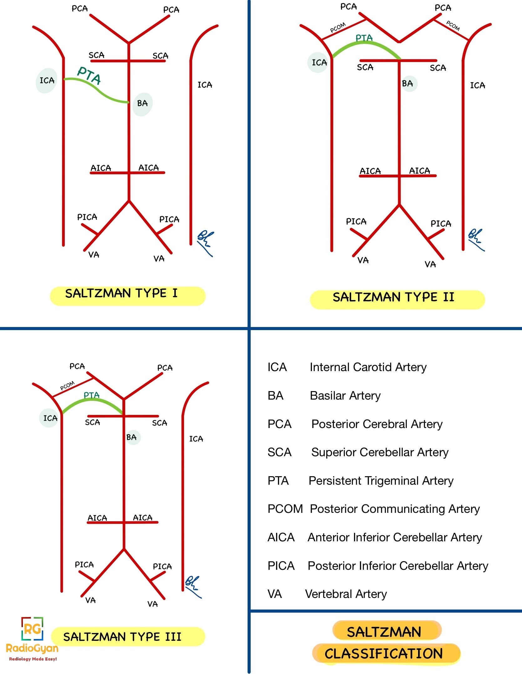 Saltzman Classification System for persistent carotid-vertebrobasilar anastomoses