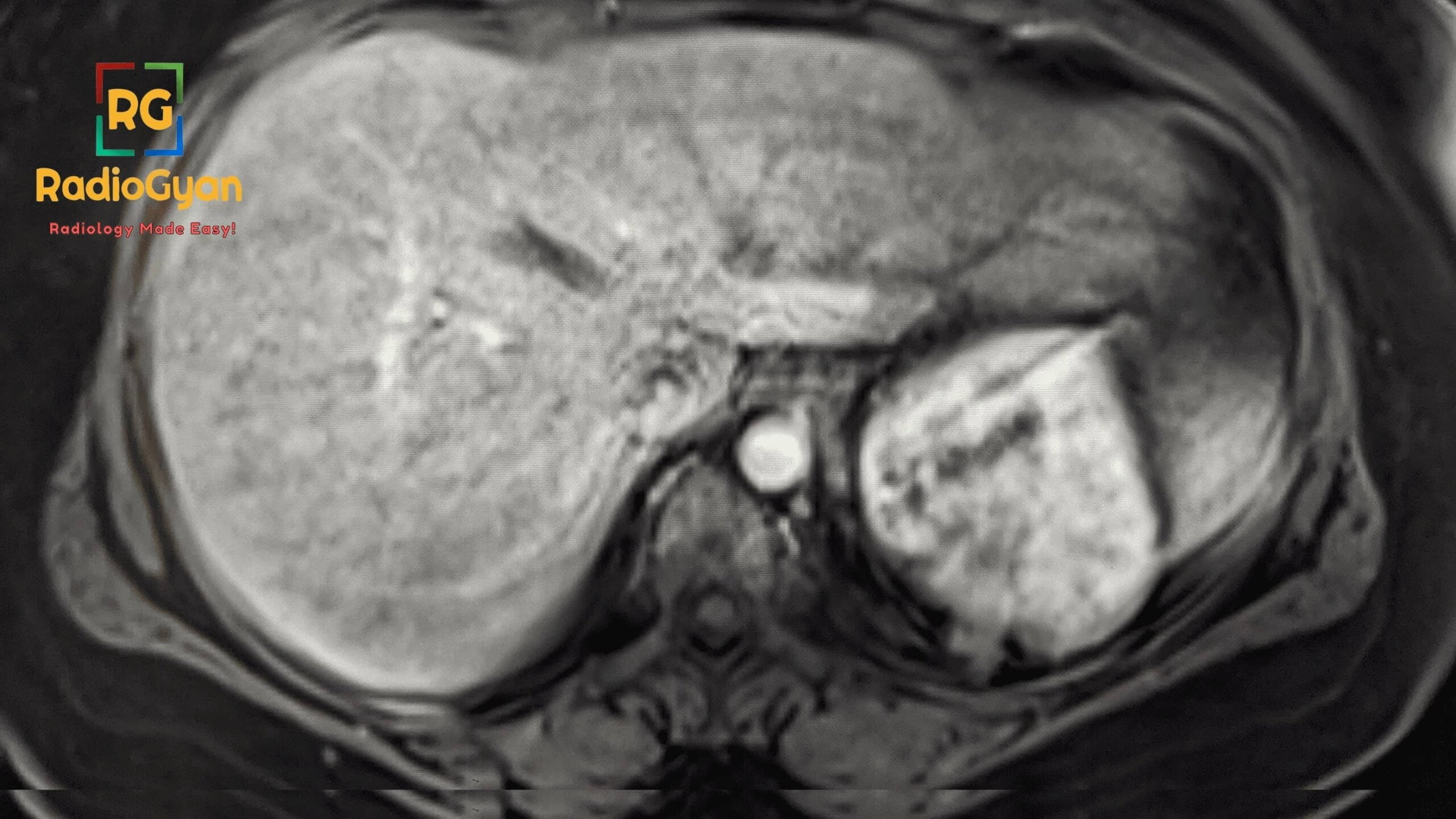 Transient Respiratory Motion Artifact During Arterial Phase MRI With Gadoxetate Disodium